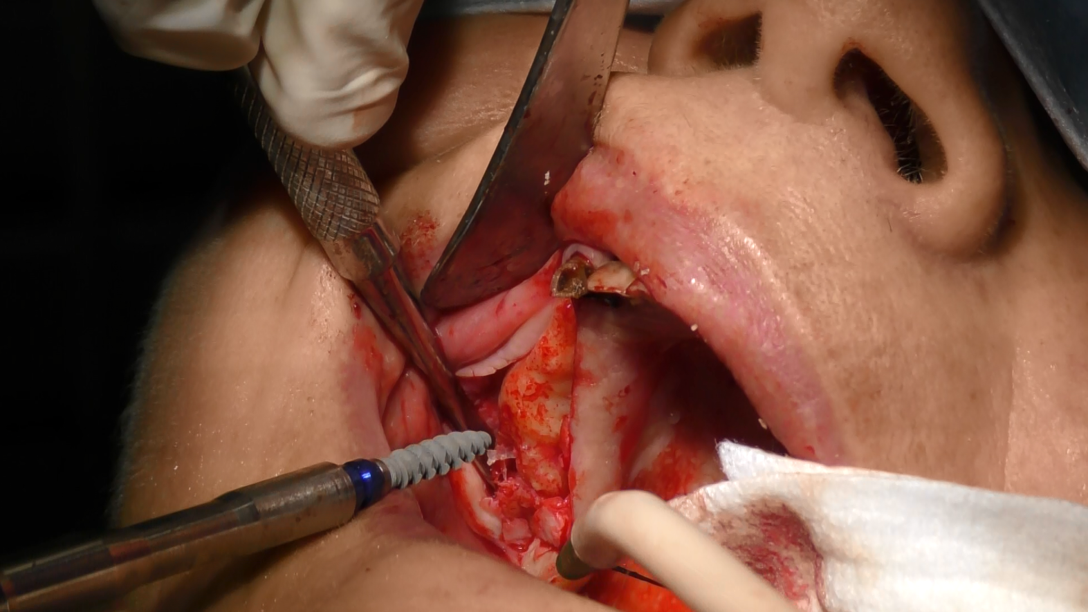 Impianti dentali pterigoidei
