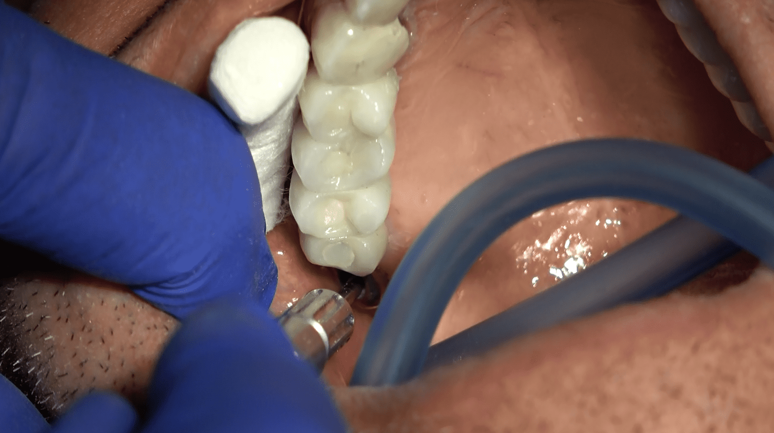 Implantologia tecnica chirurgica Galileus Cerclage Sinus®