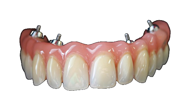 Cosa sono le Protesi dentarie?