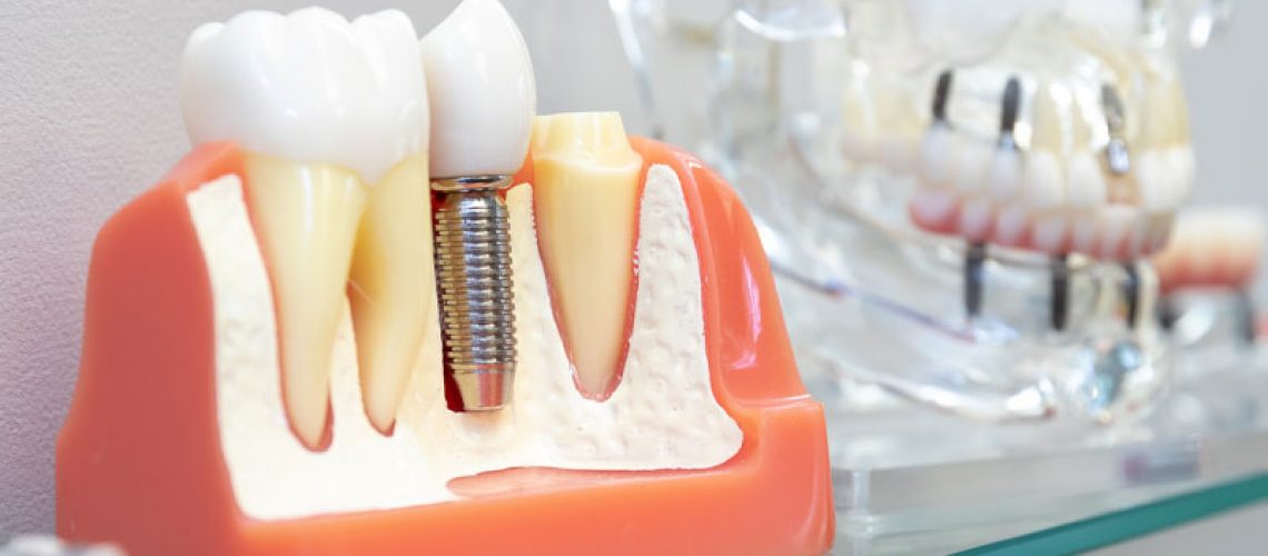 Fallimento degli impianti dentali