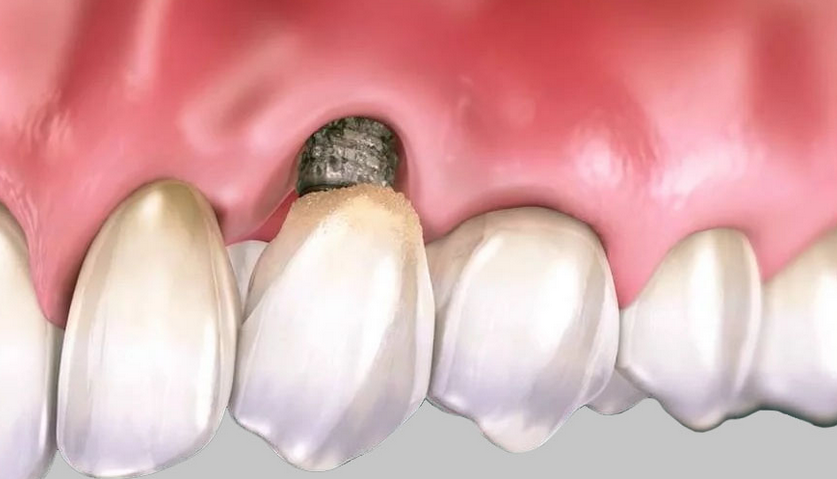 Rigetto dell’impianto dentale