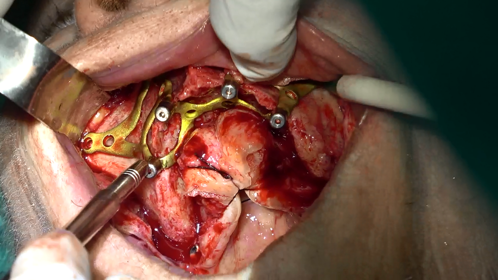 Implantologia a carico immediato senza osso sottoperiosteo