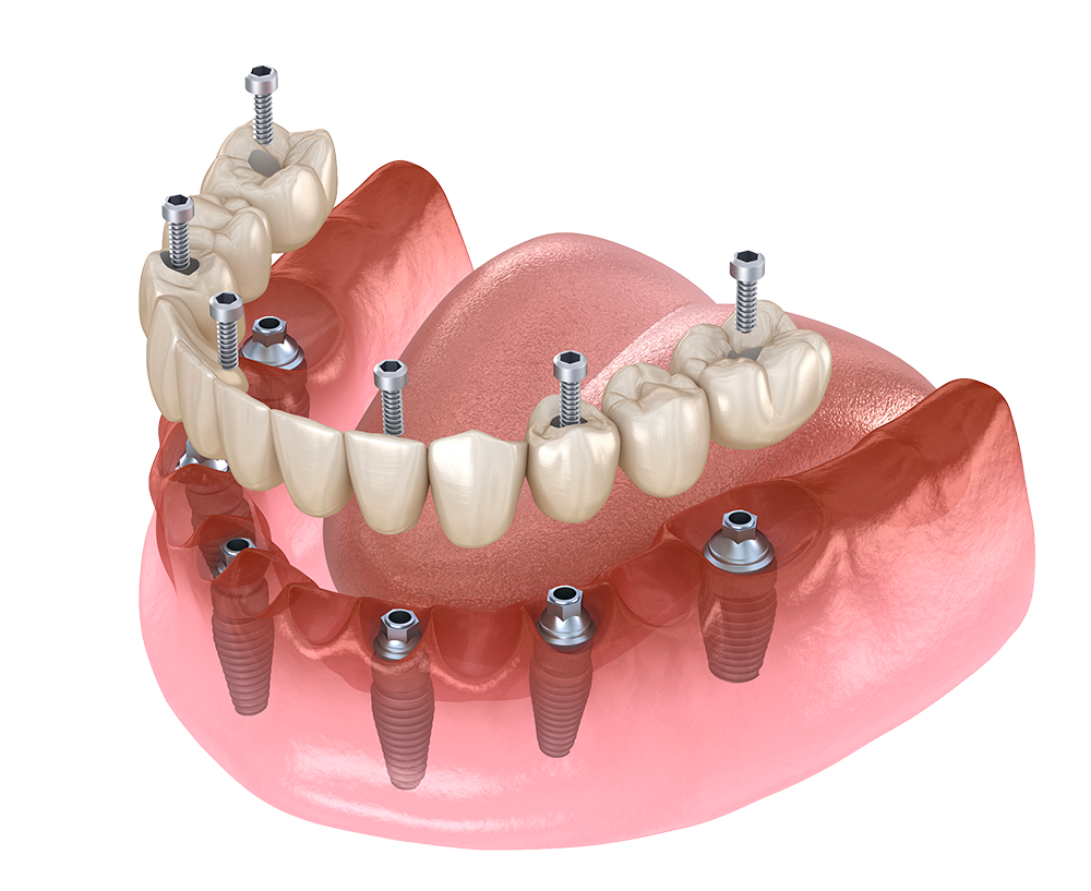Protesi dentale provvisoria