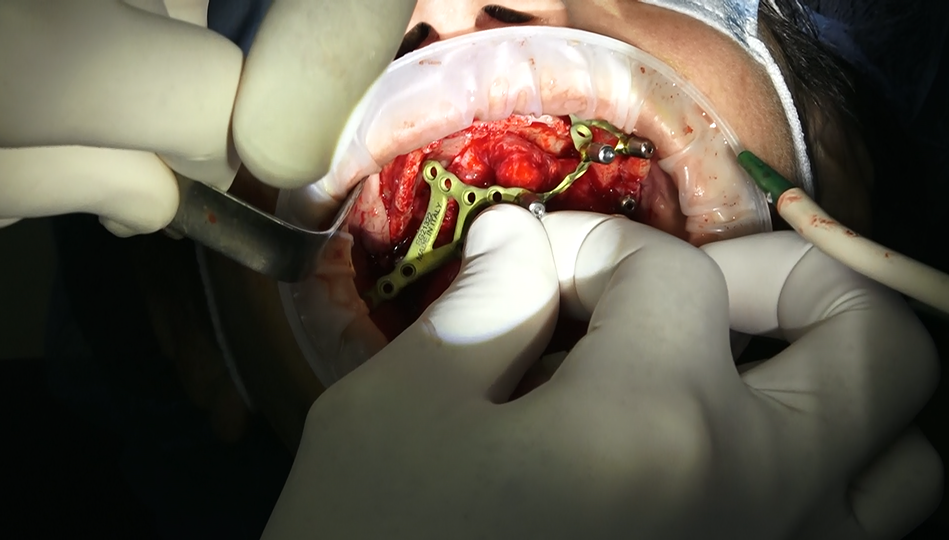 implantologia sottoperiosteo