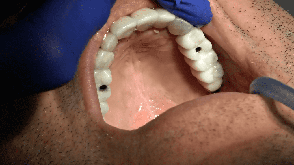 Implantologia a carico immediato Belluno