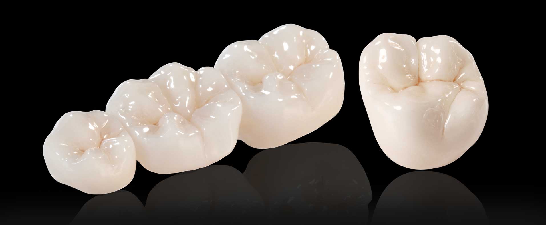 Corona dentale in ceramica