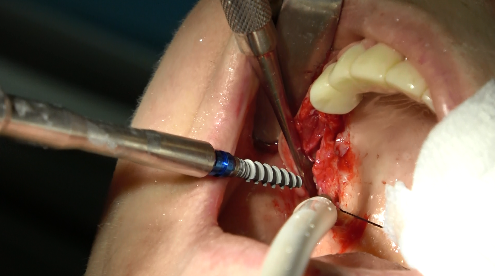 Che cosa è l’implantologia dentale?